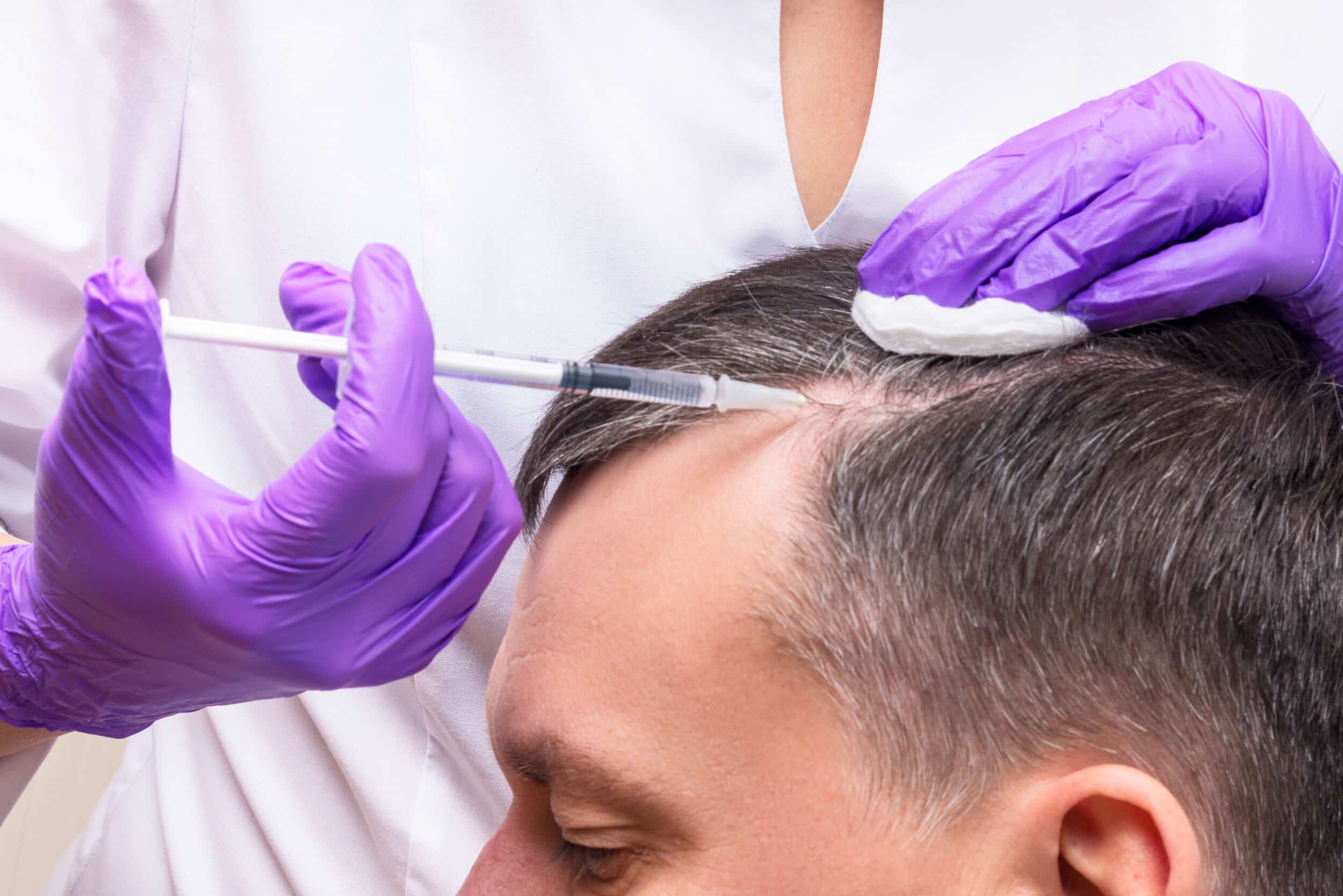 PRF Injections for Hair Loss PRF Injections for Hair Loss