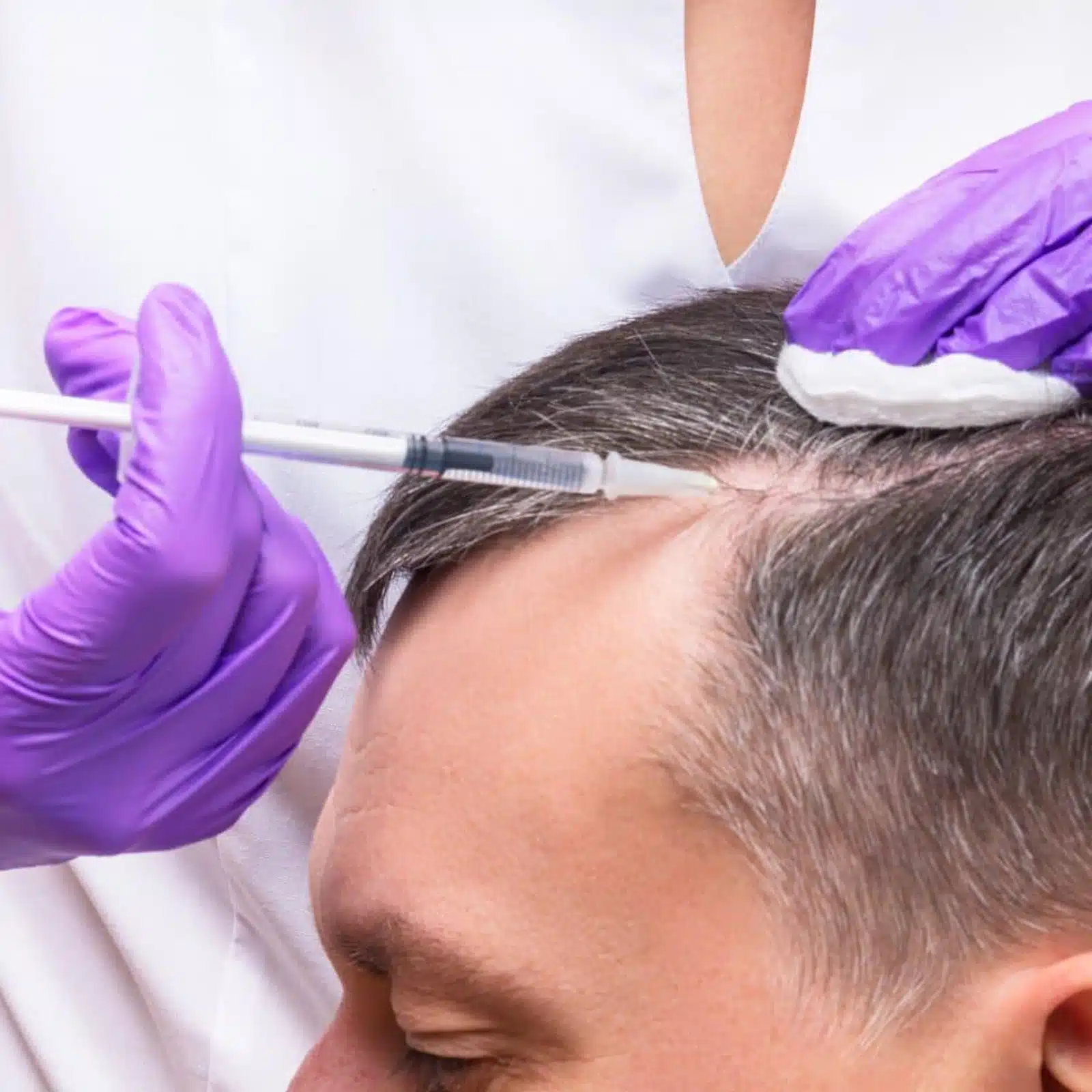 PRF Injections for Hair Loss<br />