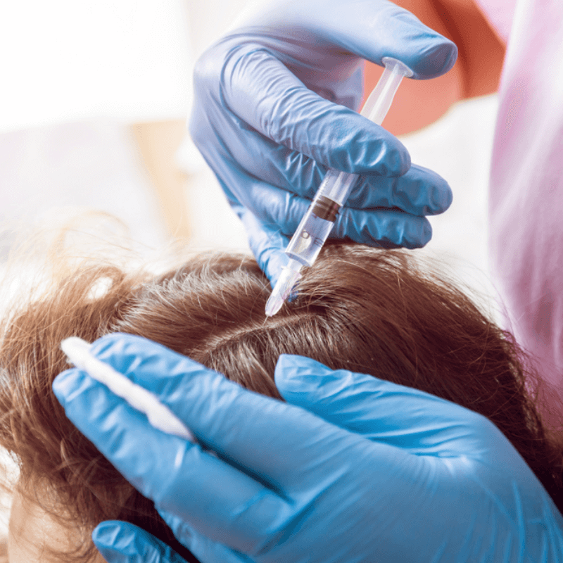 PRF Injections for Hair Loss PRF Injections for Hair Loss