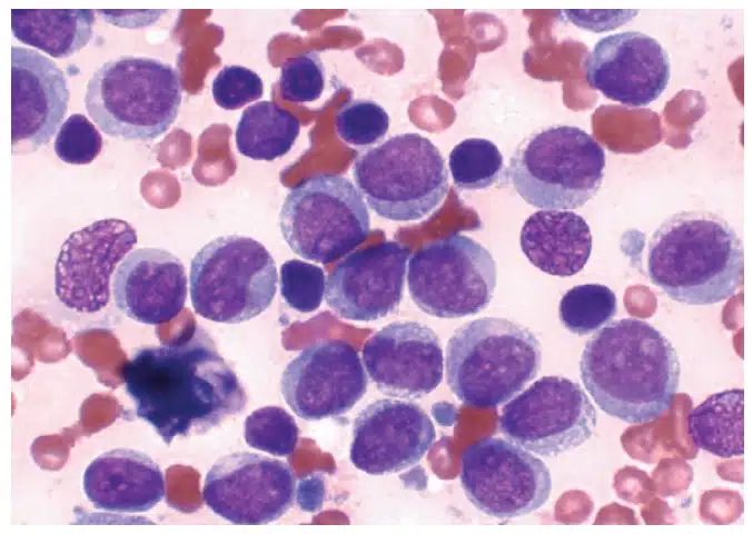 Bone Marrow Aspirate Concentrate Treatments