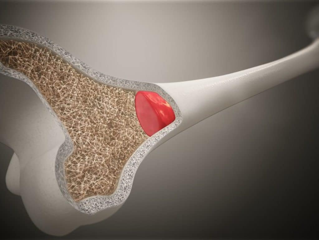 Bone Marrow Aspirate Concentrate Treatments