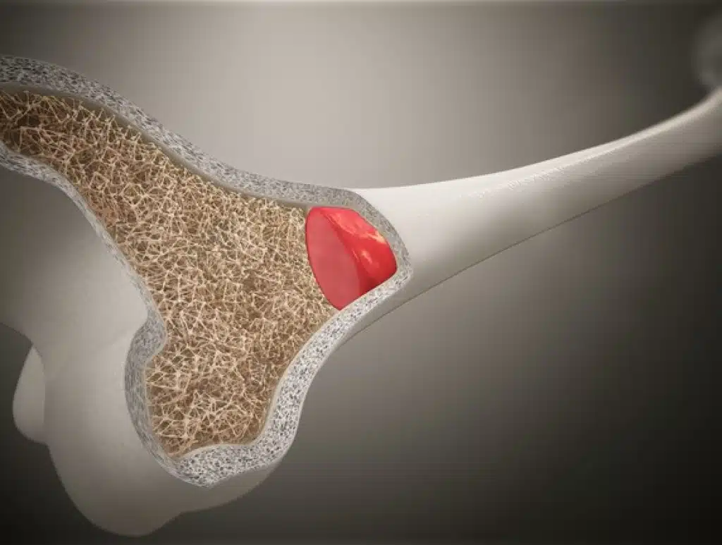 Bone Marrow Aspirate Concentrate Treatments
