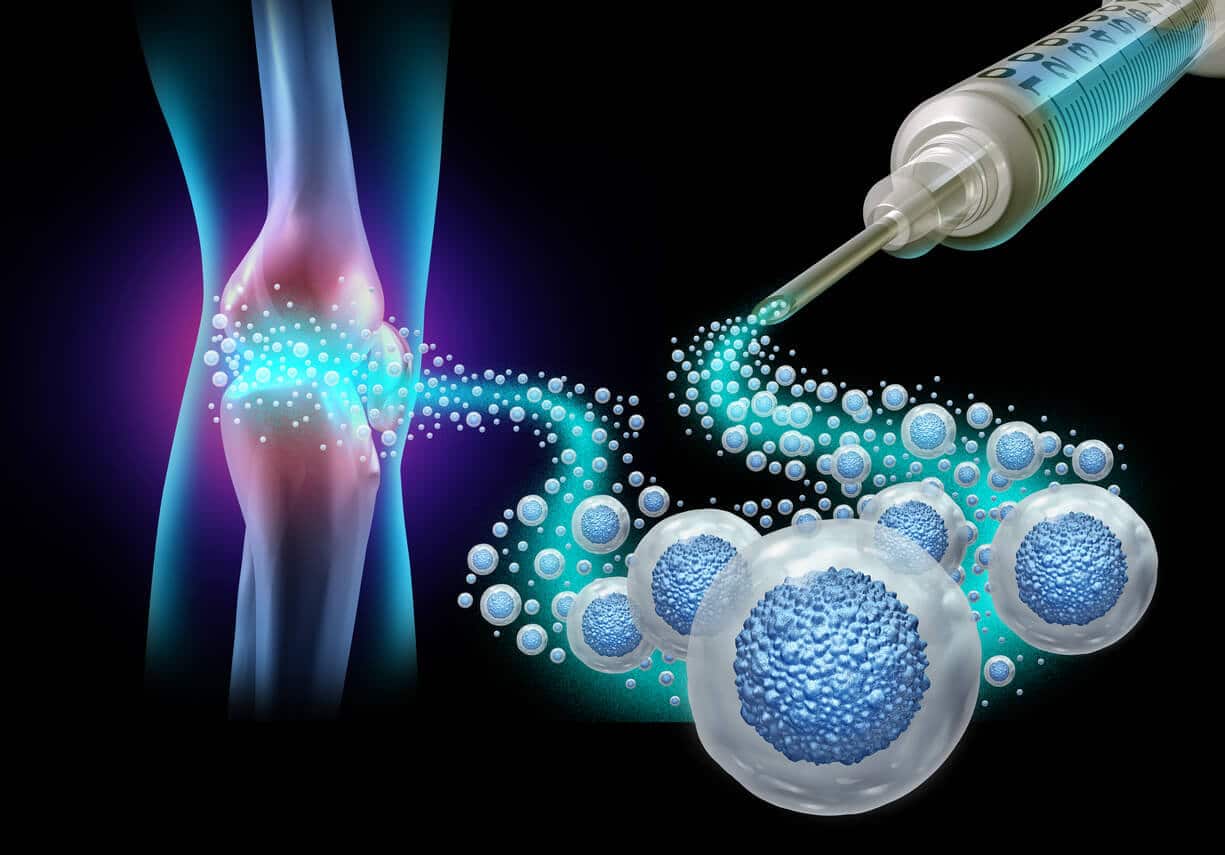 Illustration of a cell injection into the knee joint Illustration of a cell injection into the knee joint