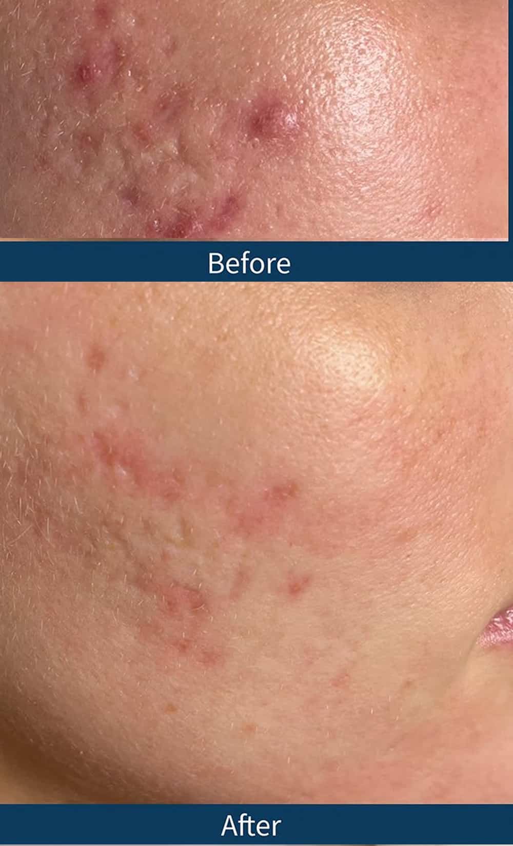 Exosome Therapy Before and After Exosome Therapy Before and After