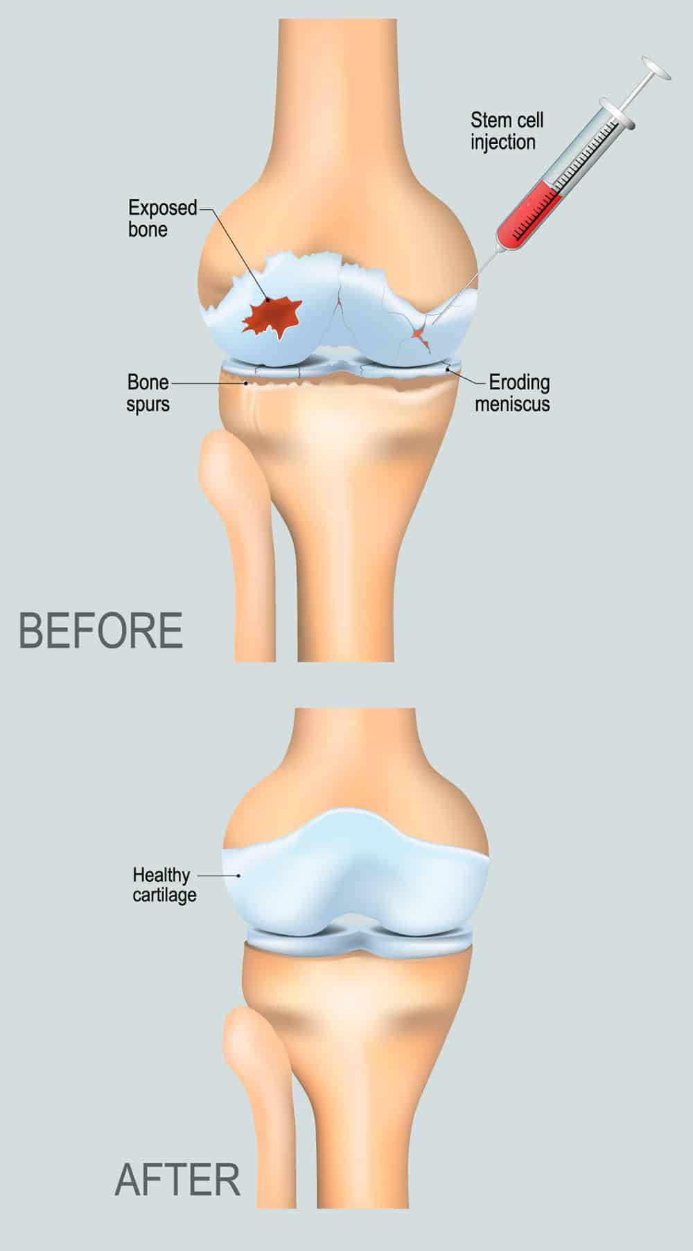 : Stem Cell Injections Before and After : Stem Cell Injections Before and After