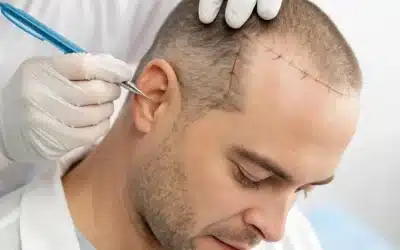 Advanced Hair Transplant in Orlando for Natural, Permanent Results
