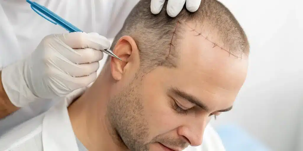 Hair Transplant Orlando