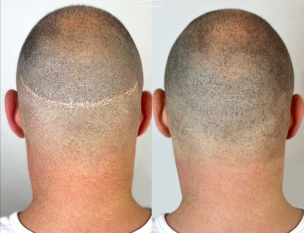 Hair Transplant Orlando