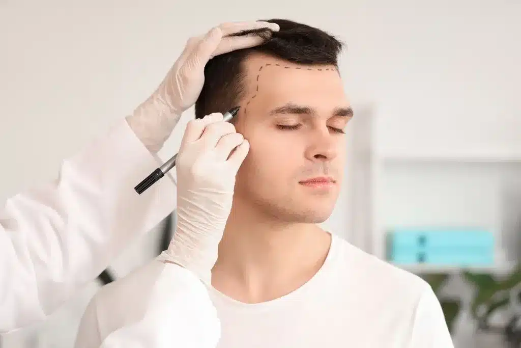 Hair Transplant Orlando