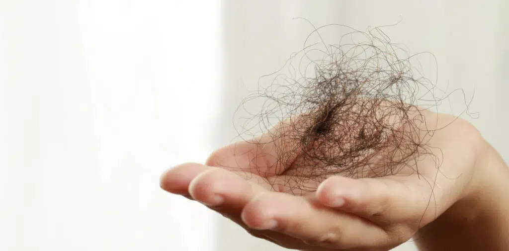 Hair Restoration In Orlando