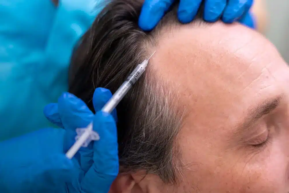 Hair Restoration In Orlando