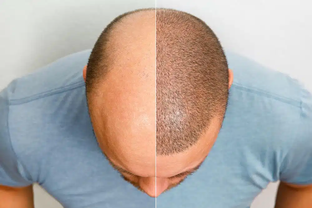 Hair Transplant Orlando