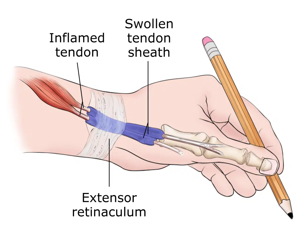 Hand Tendonitis