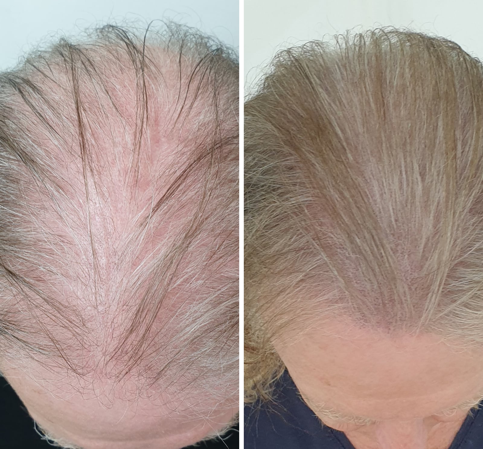 Long-Lasting, Natural Results