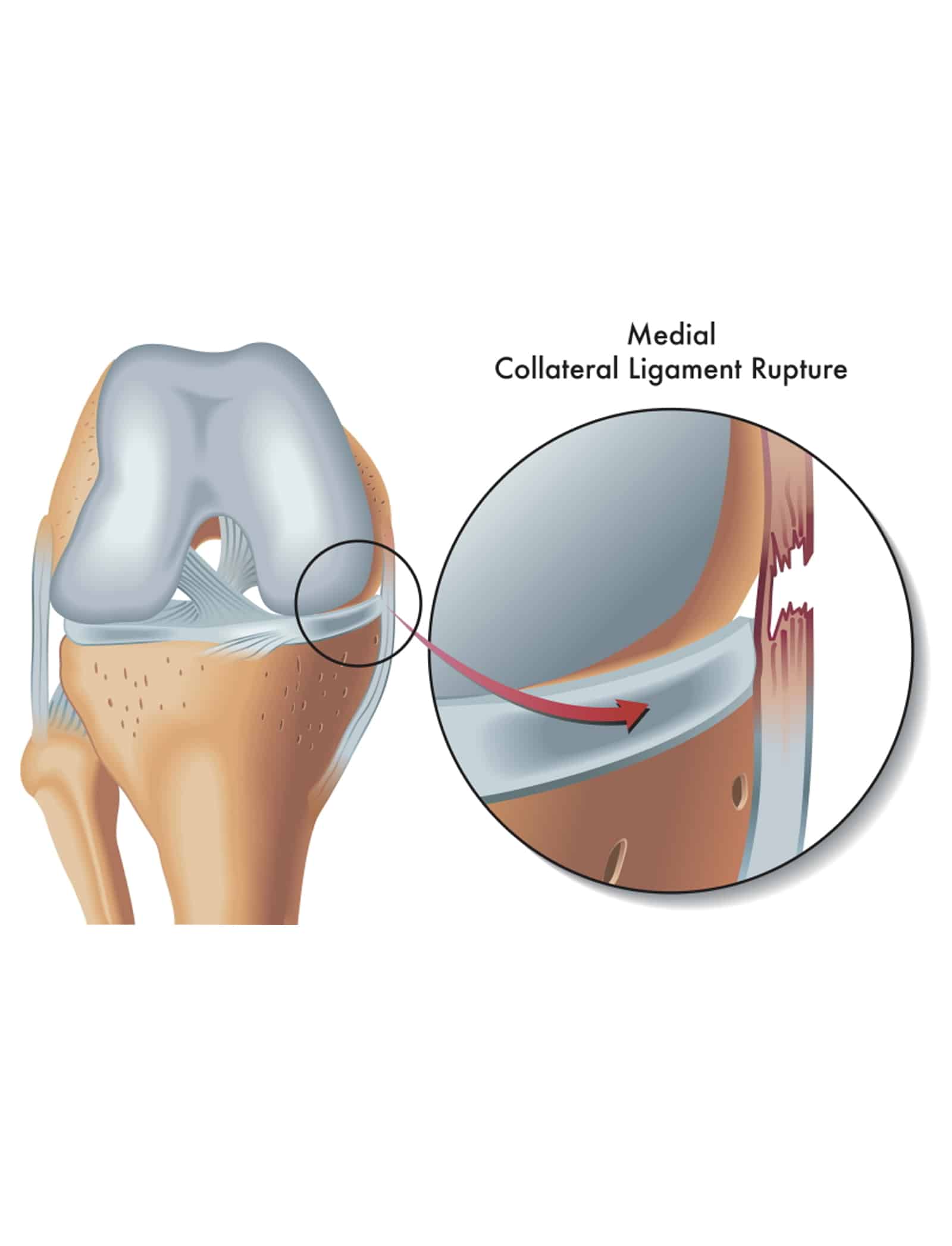 Symptoms of a Knee Pain Injury sharp pain