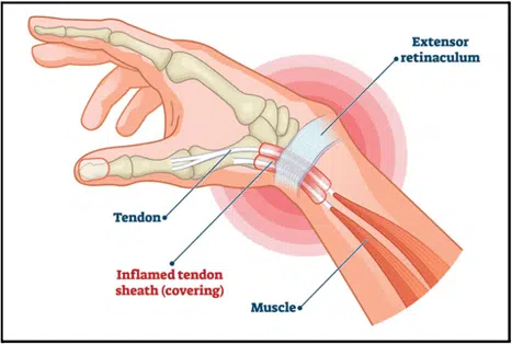 Wrist Joint Pain