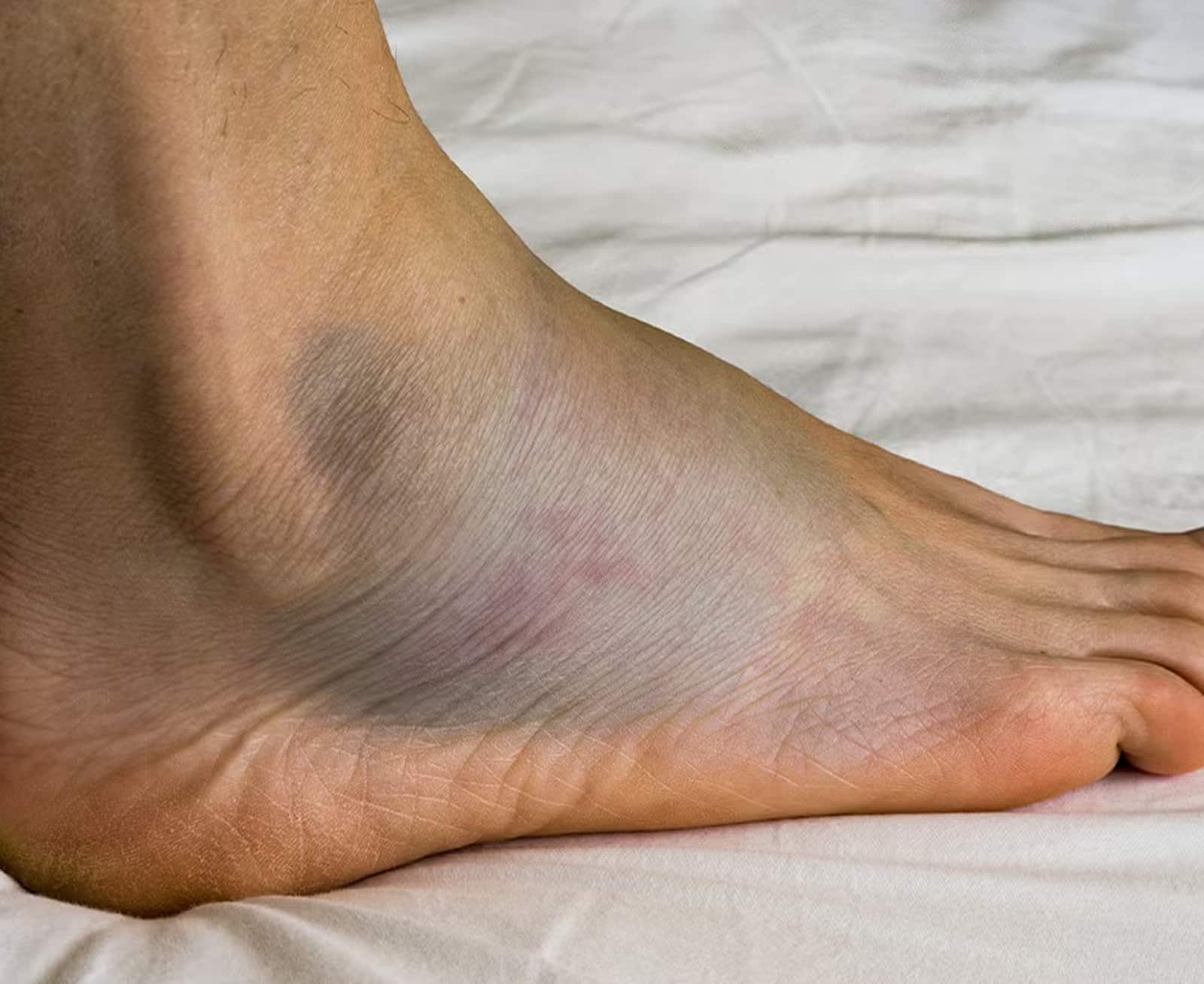 Ankle Pain and Swelling Ankle Pain and Swelling