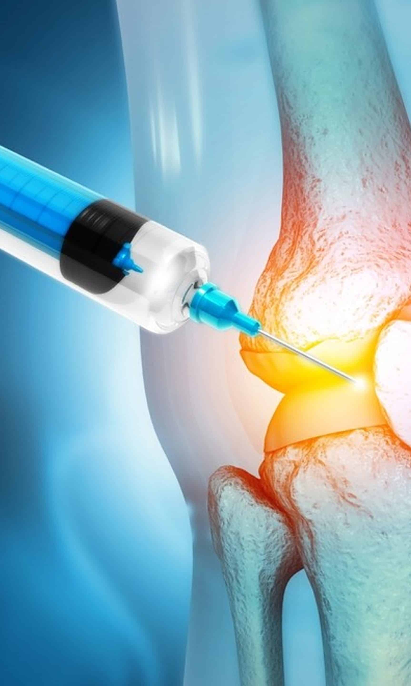 Viscosupplementation Viscosupplementation