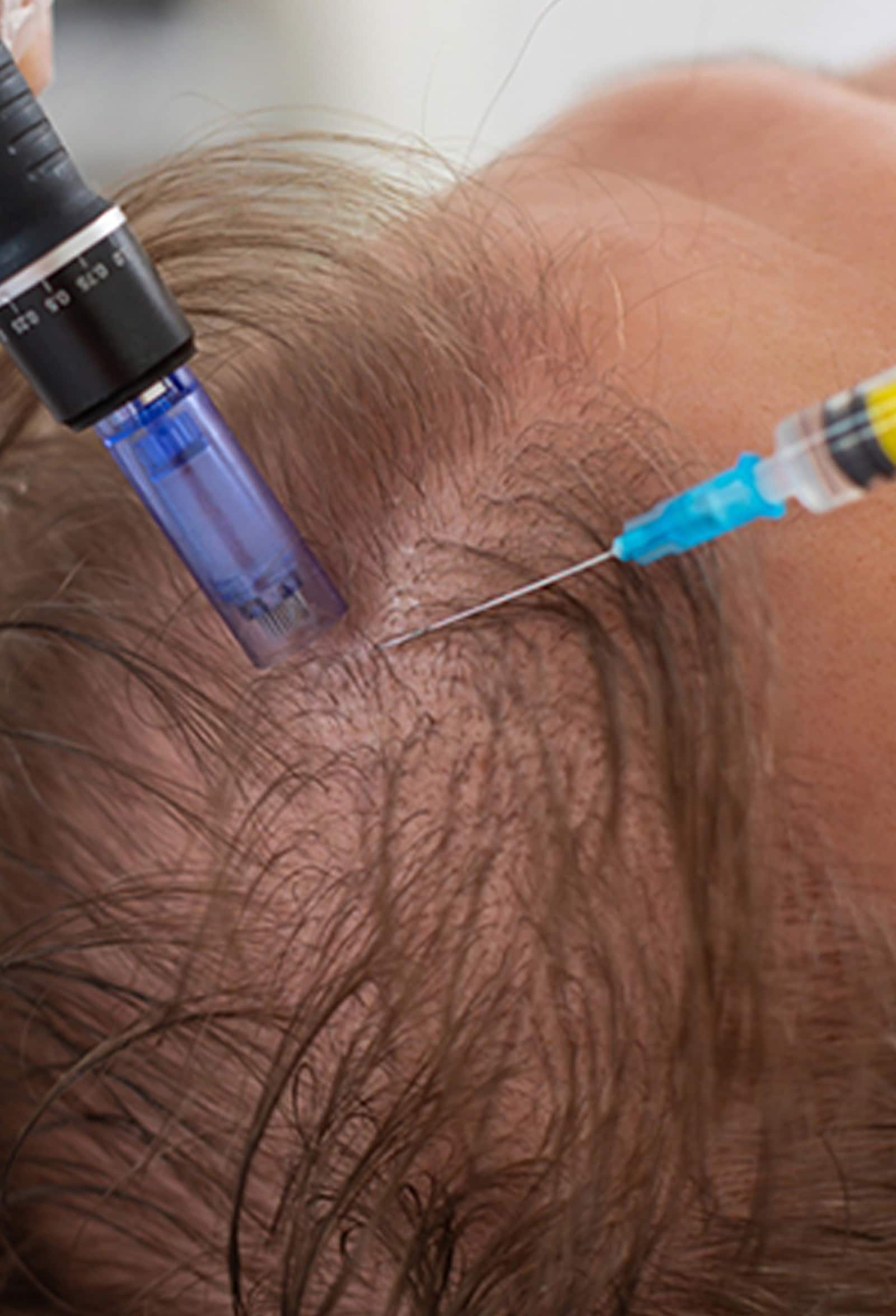 First Step Toward Hair Restoration