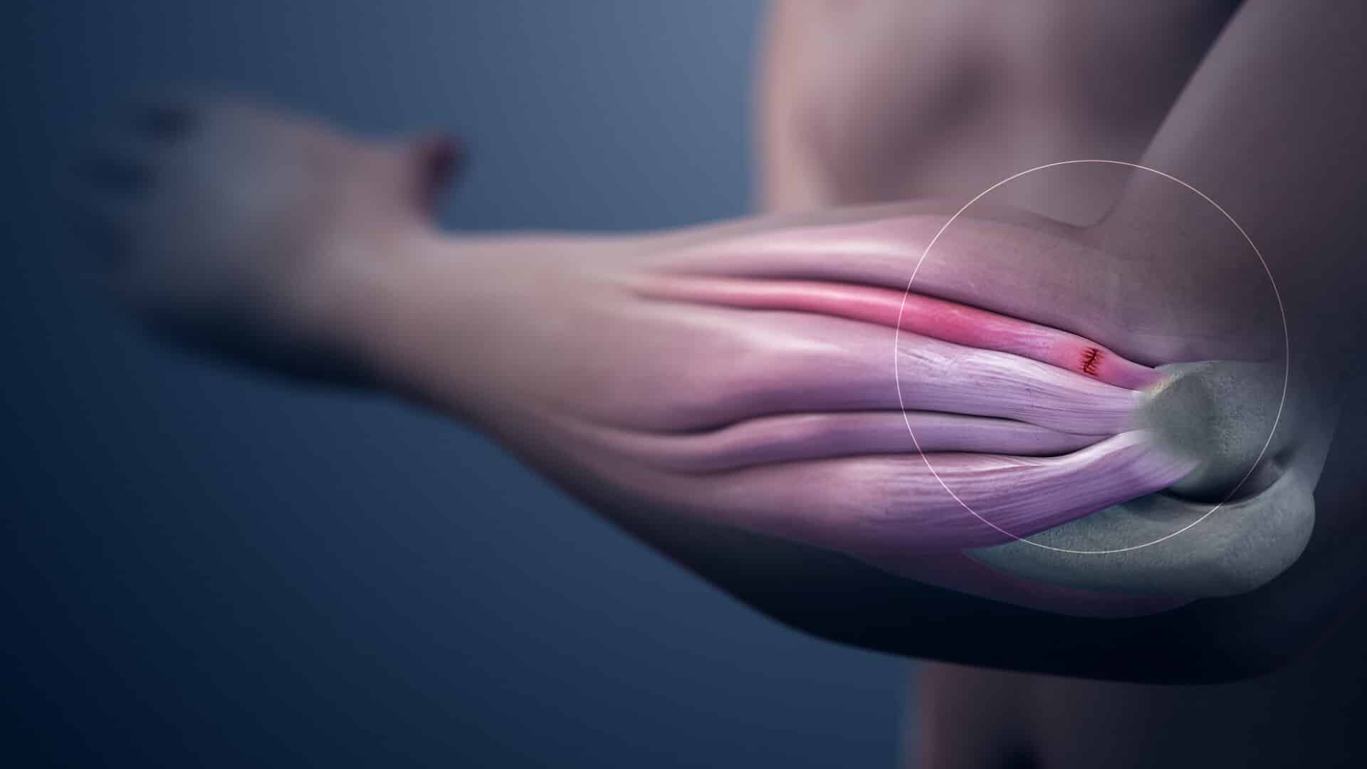 Ligament Injuries Winter Park