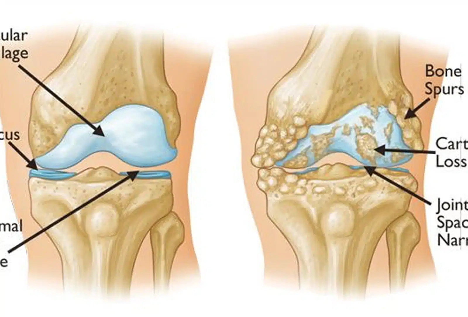 Osteoarthritis Treatment