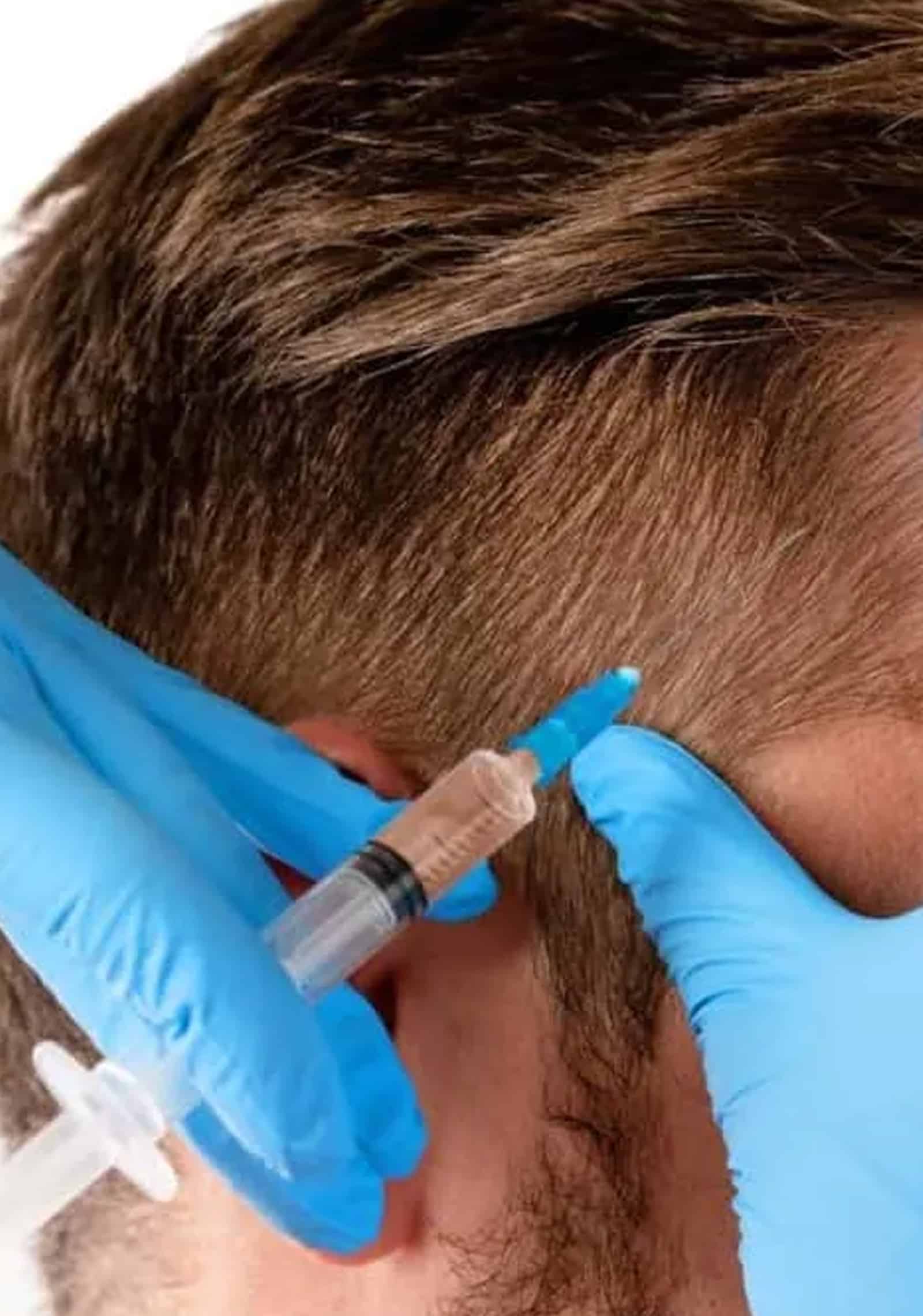 Hair Follicles with PRF Therapy Hair Follicles with PRF Therapy