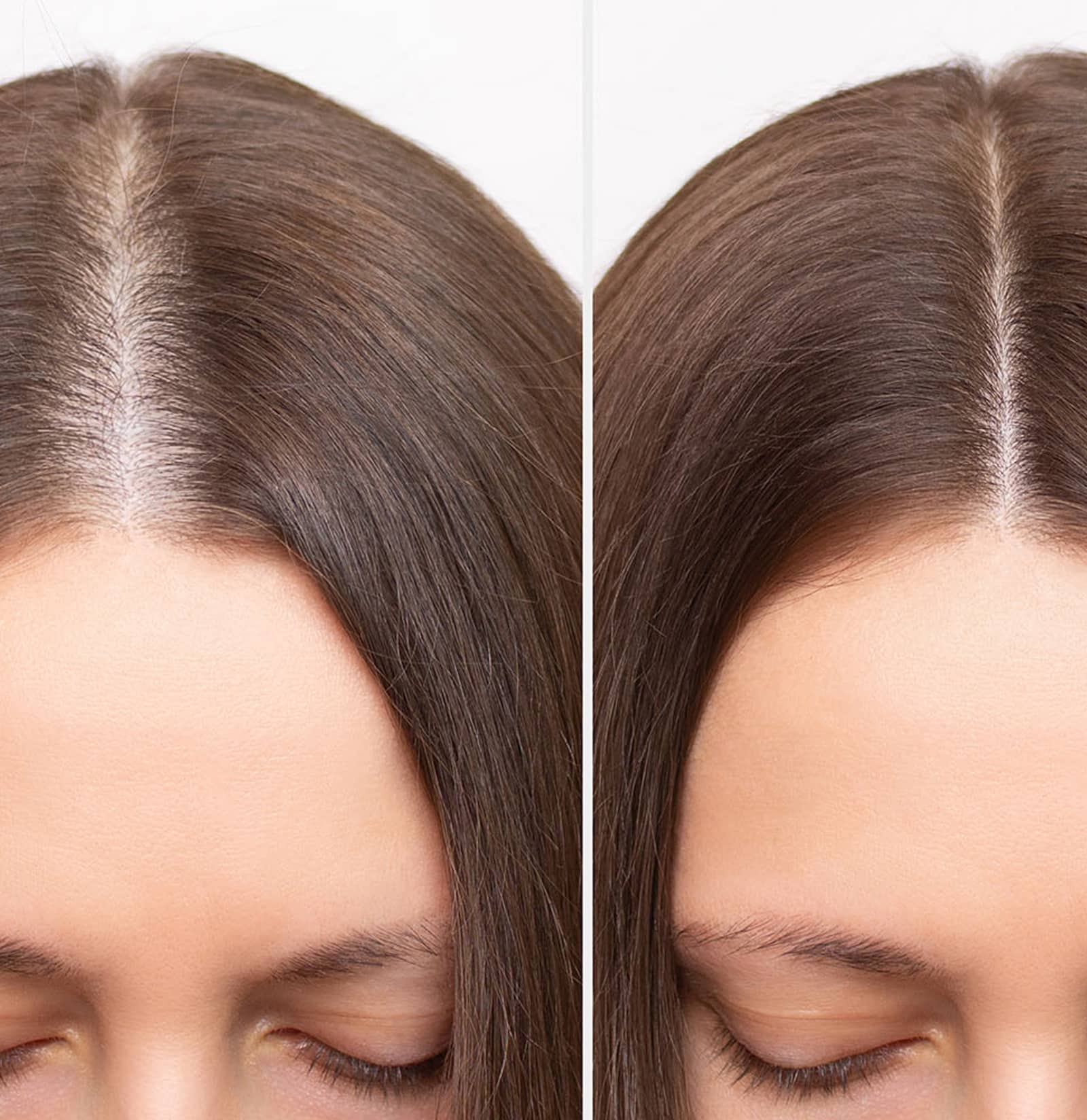 PRF Hair Restoration Is Right for You PRF Hair Restoration Is Right for You