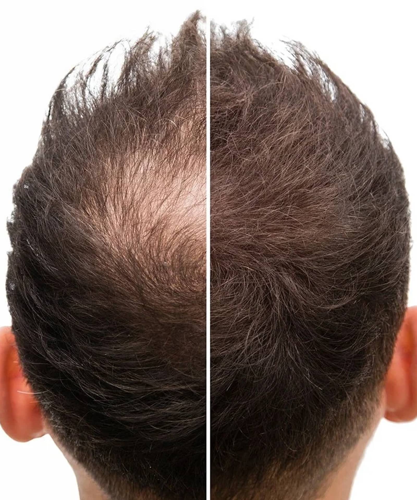 The Next Evolution in Hair Restoration The Next Evolution in Hair Restoration