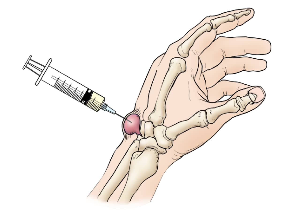 wrist joint pain orlando