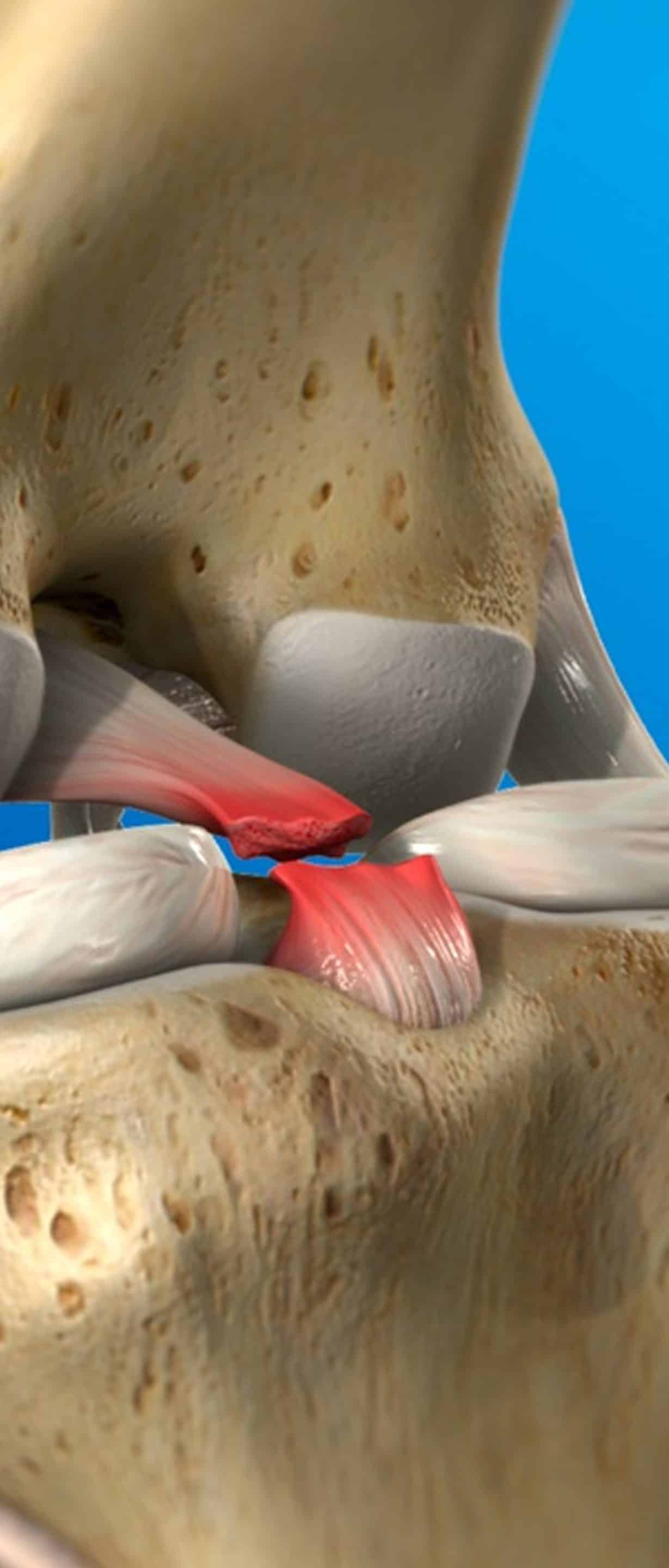 Approach to Healing Ligament Injuries Approach to Healing Ligament Injuries
