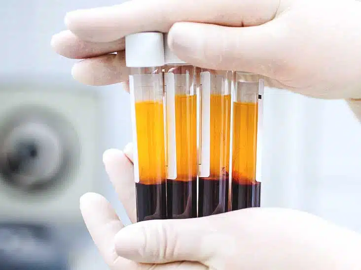 prp therapy for headaches: does it work?