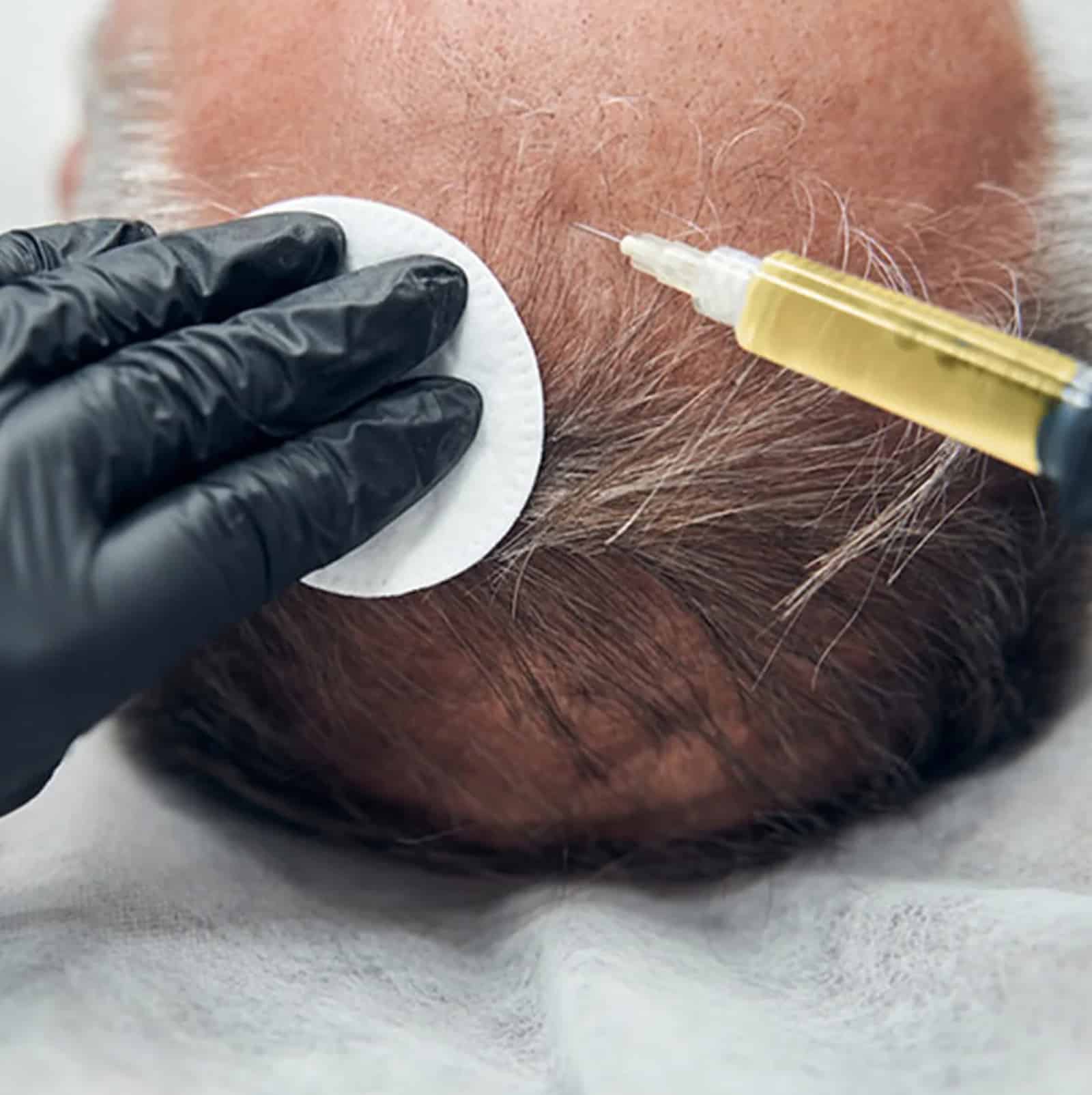 Benefits Most from PRF Hair Treatment PRF Injections for Hair Loss