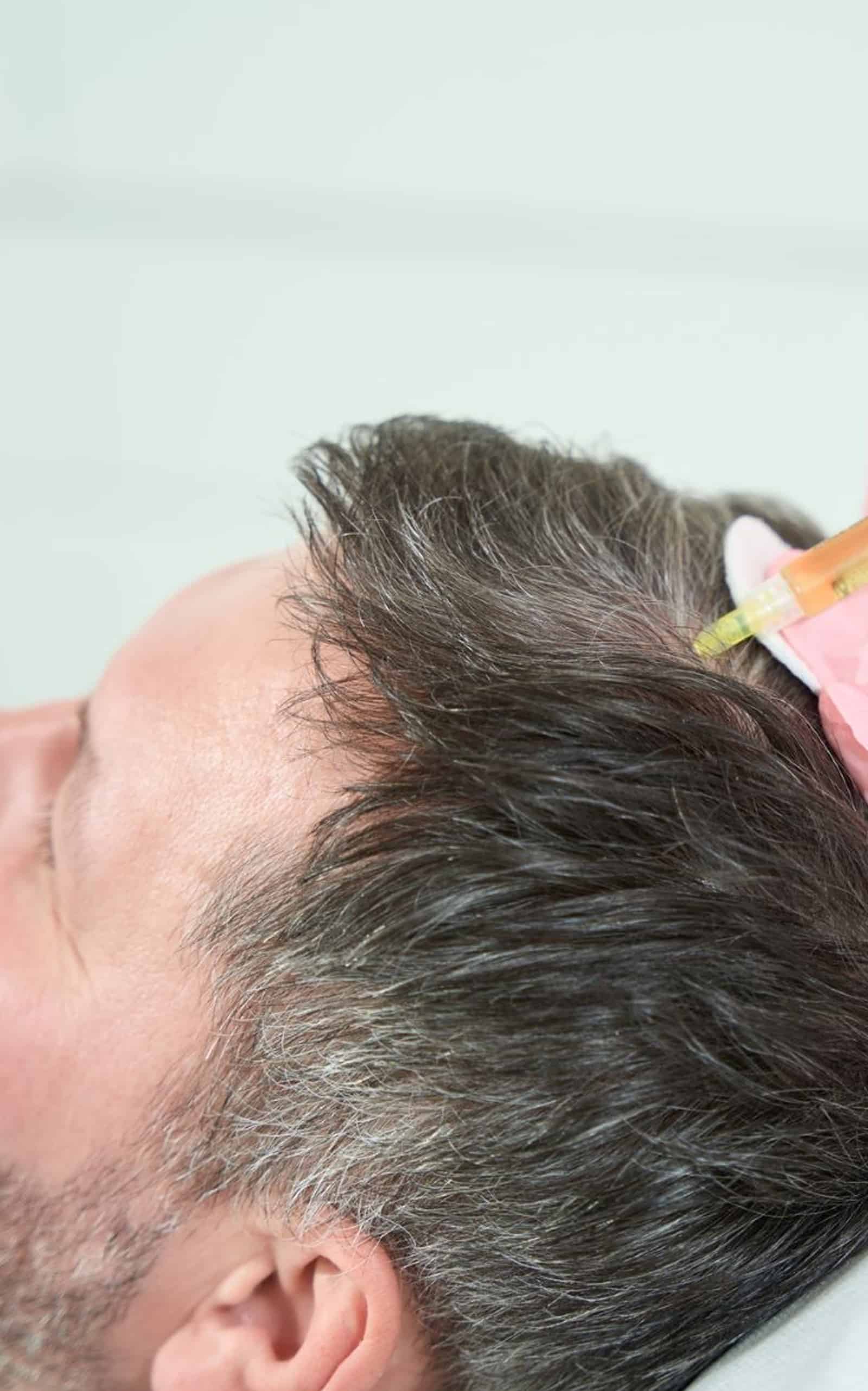 Gentle Centrifugation Process PRF Injections for Hair Loss