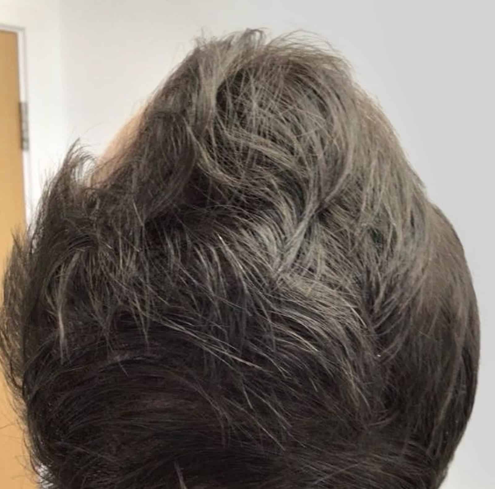 Patients Choose Winter Park Regenerative Medicine PRF Injections for Hair Loss