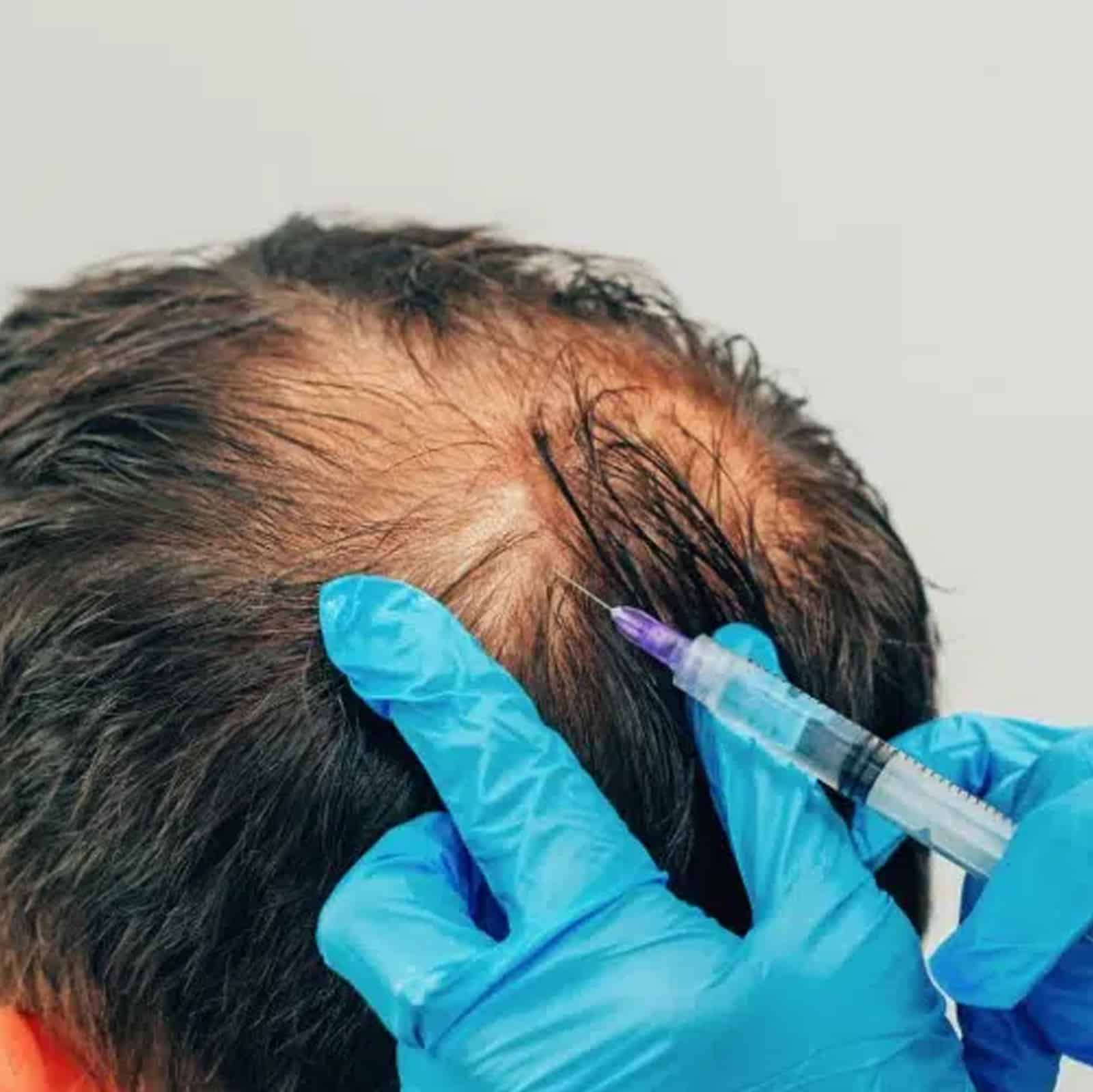 Platelet-Rich Plasma (PRP) Therapy