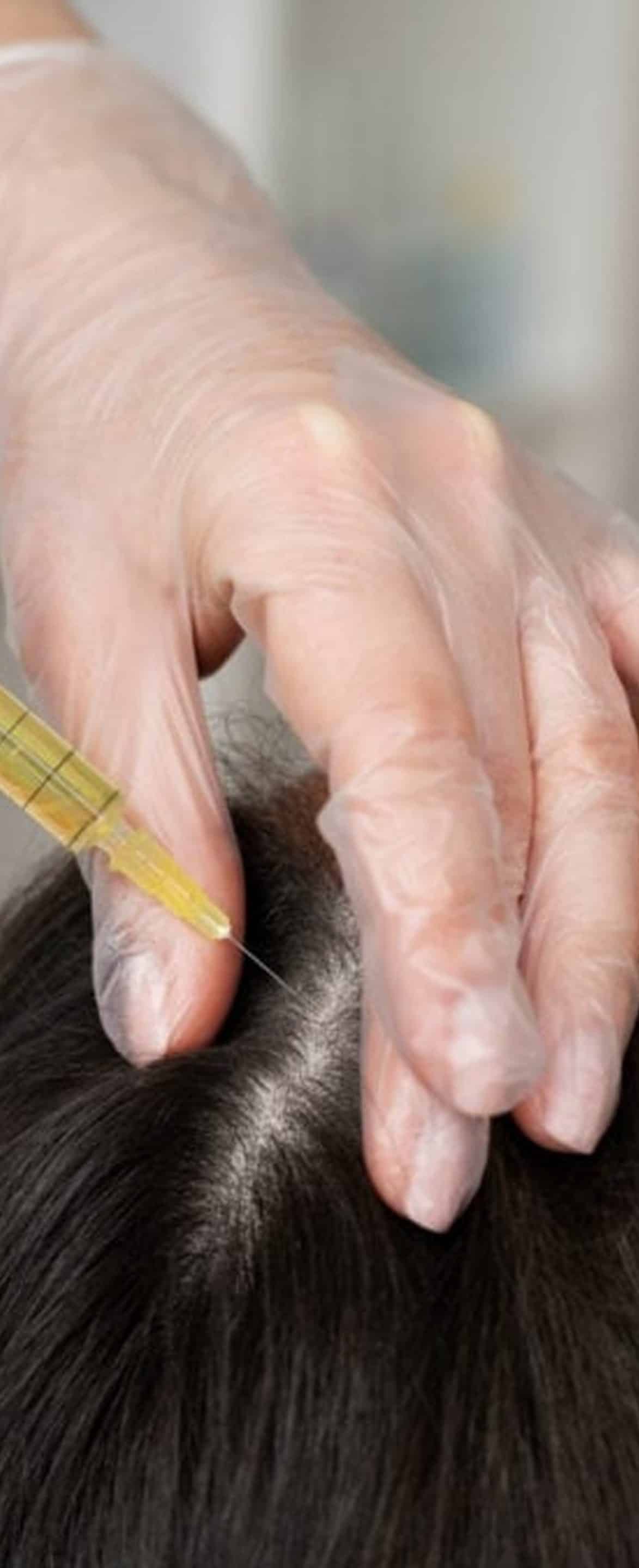 Platelet-Rich Plasma (PRP) Facet Joints