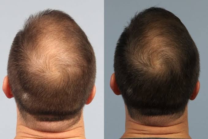 Results Timeline PRF Injections for Hair Loss